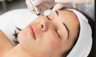 IPL odstranění žilek a pigmentace